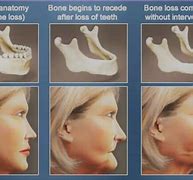 Image result for Jaw Bone Loss Symptoms