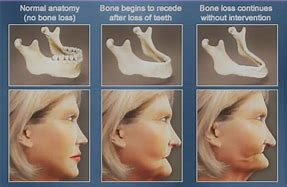 Image result for Lower Jaw Bone Loss