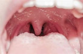 Image result for Uvulitis