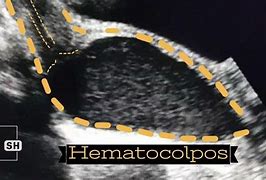 Image result for hemoptoico