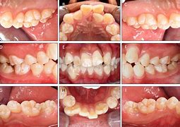 Image result for Teeth Fused to Jawbone