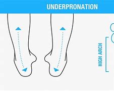 Image result for Foot Underpronation