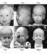 Image result for co_to_za_zespół_progerii_hutchinsona gilforda