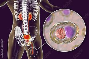 Image result for Chlamydia Trachomatis Infection