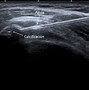 Image result for calcificad