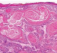 Image result for Invasive Squamous Cell Carcinoma
