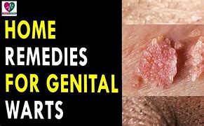 Image result for Genital Warts Home Treatment