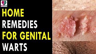 Image result for Garlic Genital Wart