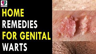 Image result for Fast Genital Wart Removal