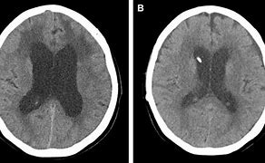 Image result for VP Shunt in Hydrocephalus