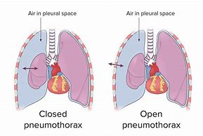 Image result for Pneumothorax Chest Tube