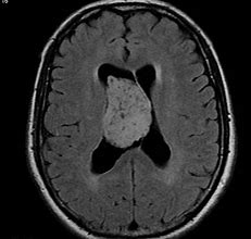 Image result for Choroid Plexus Papilloma MRI