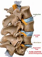 Image result for Cervical Spine Subluxation
