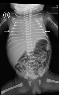 Image result for RSV Chest X-ray