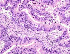 Image result for Borderline Mucinous Ovarian Tumor