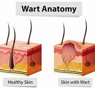 Image result for Wart Disection
