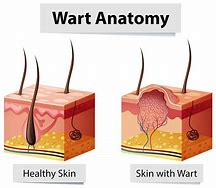 Image result for Wart Cross Section