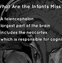 Image result for Sad Anencephaly