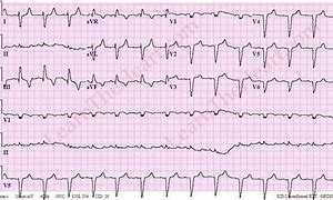 Image result for Axis Deviation ECG