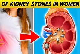 Image result for Female Kidney Stones