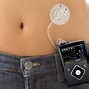 Image result for Type 2 Insulin Pump