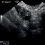 Image result for Ultrasound Cyst Adjacent to Ovary