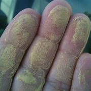 Image result for Pollen Food Allergy