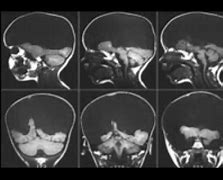 Image result for Hydranencephaly Survival