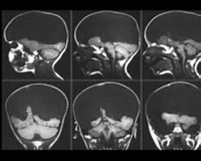 Image result for Hydranencephaly