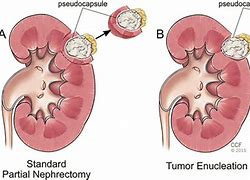 Image result for Left Lower Pole Kidney Mass