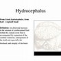 Image result for Hydrocephalus Treatments