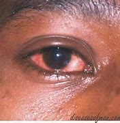 Image result for Gonorrhea of the Eye