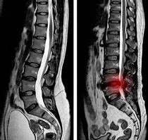 Image result for Collapsed Disc in Back