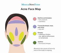 Image result for Face Mapping Acne