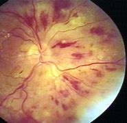 Image result for Cotton-Wool Spots Oict