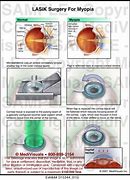 Image result for Lasik Surgery for Myopia