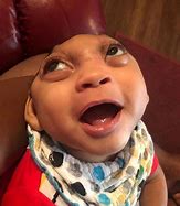Image result for Baby Born with Brain Outside of Head