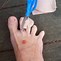 Image result for Picture of Moleskin Applied to a Blister