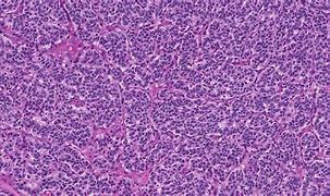Image result for karcinoid