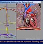 Image result for What Is Carotid Upstroke