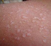 Image result for SunBurn On Dark Skin