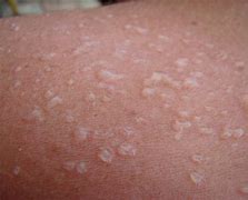 Image result for Sun Burn Purple Skin