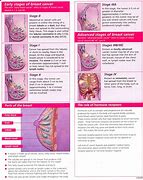 Image result for Stages of Cancer Tumor Size