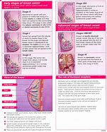 Image result for Cancer Stages Explained