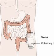 Image result for colostom�a