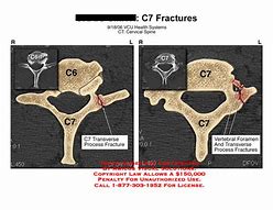 Image result for C7 Fracture Symptoms