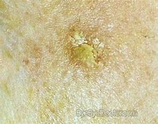 Image result for Liquid Nitrogen Reaction Face Actinic Keratosis