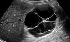 Image result for Complex Cyst On Kidney USG Doppler