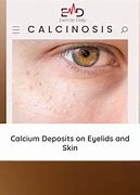 Image result for Calcium Eruptions in Skin
