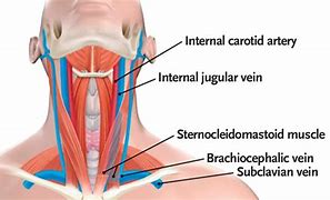 Image result for Distended Carotid Artery